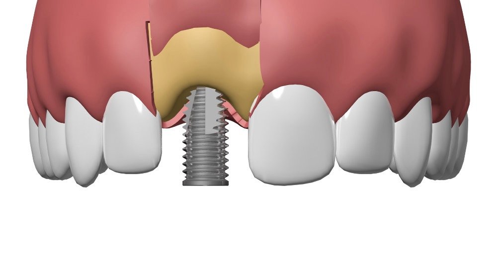 Implant dentaire Nimes